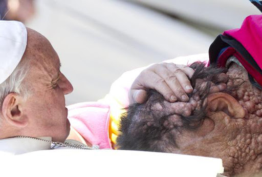 pope francis embraces man with disfigured face &#8211; it