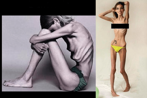 adolescenti che rifiutano il cibo (anoressia, bulimia) &#8211; it