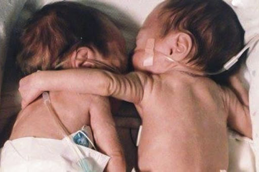 Twins rescued by hug at birth &#8211; it