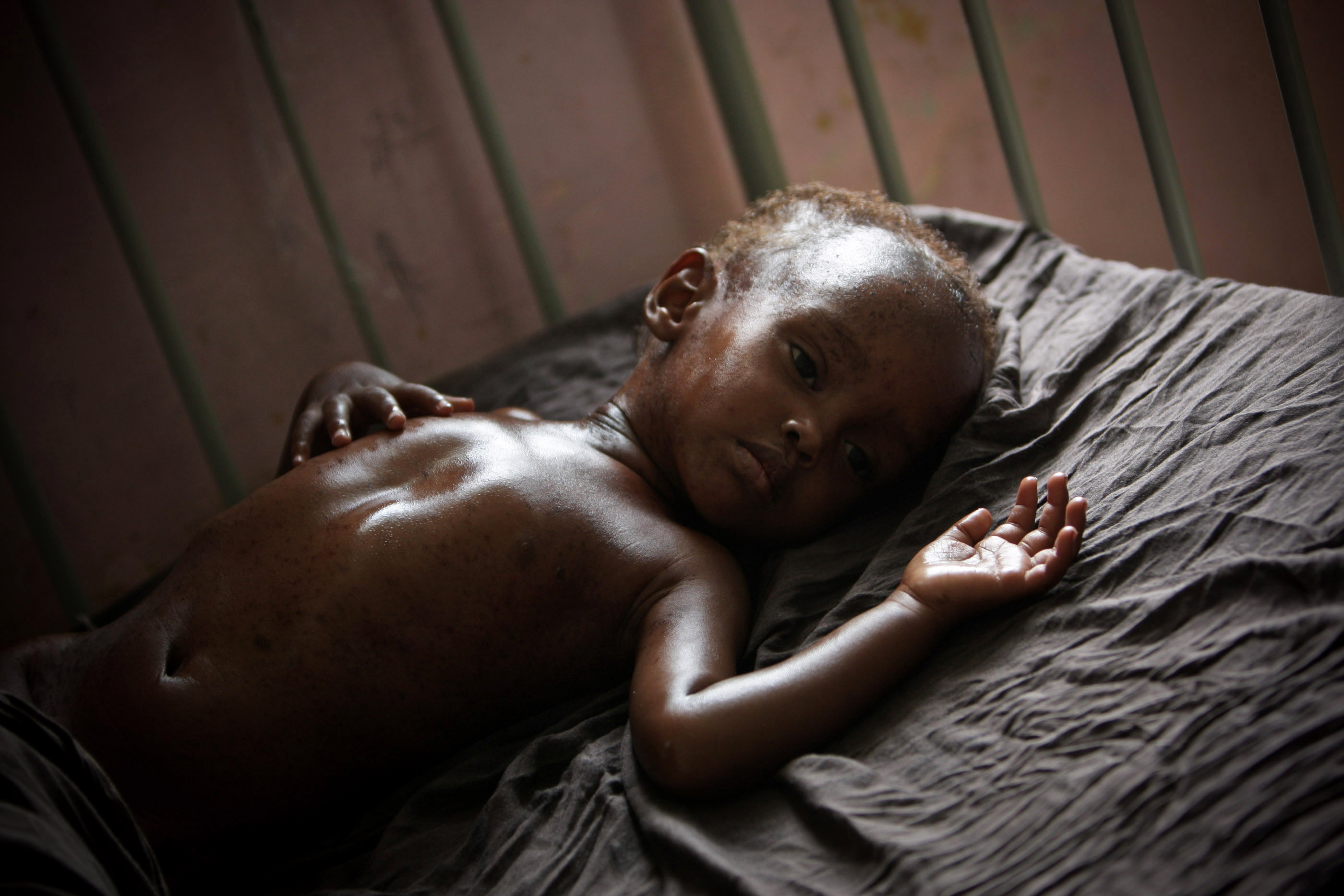 SOMALIA, Mogadishu: In a photograph released by the African Union-United Nations Information Support Team 10 August, a malnourished and dehydrated child lies on a bed in Banadir Hospital in the Somali capital Mogadishu. Somalia is gripped by a devastating drought and famine that has already killed tens of thousands and leaving many hundreds of thousands more, particularly young children and babies, in desperate need of emergency life-saving humanitarian assistance from the outside world. AU-UN IST PHOTO / STUART PRICE.