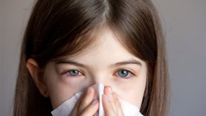 ALLERGIC CONJUNCTIVITIS,